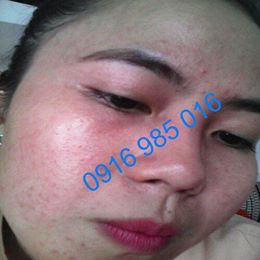 Pé Hiền Tái Tạo Da Bằng Thảo Dược Trị Mụn Thanh Trang Pé Hiền Tái Tạo Da Bằng Thảo Dược Trị Mụn Thanh Trang