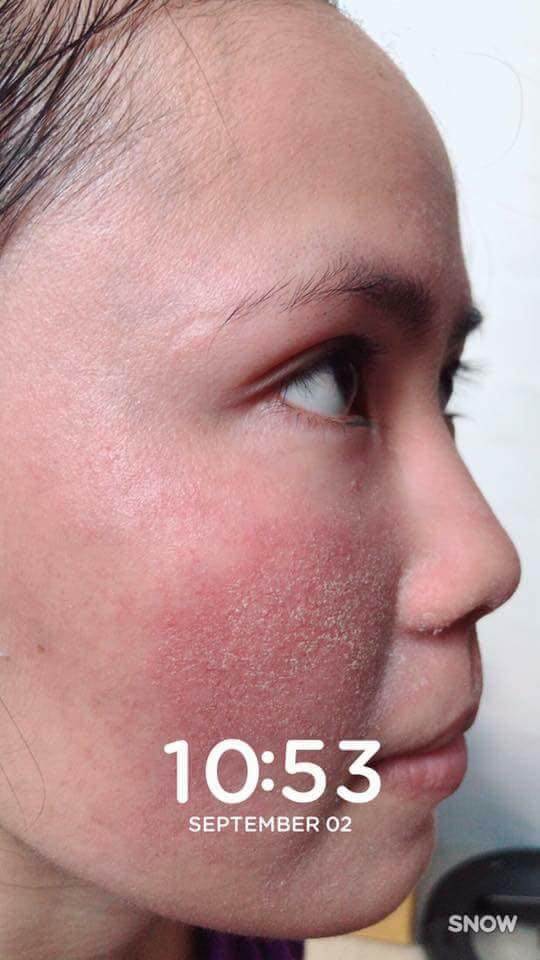 Pé Hiền Tái Tạo Da Bằng Thảo Dược Trị Mụn Thanh Trang Pé Hiền Tái Tạo Da Bằng Thảo Dược Trị Mụn Thanh Trang