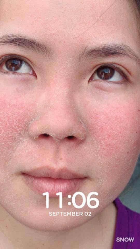 Pé Hiền Tái Tạo Da Bằng Thảo Dược Trị Mụn Thanh Trang Pé Hiền Tái Tạo Da Bằng Thảo Dược Trị Mụn Thanh Trang