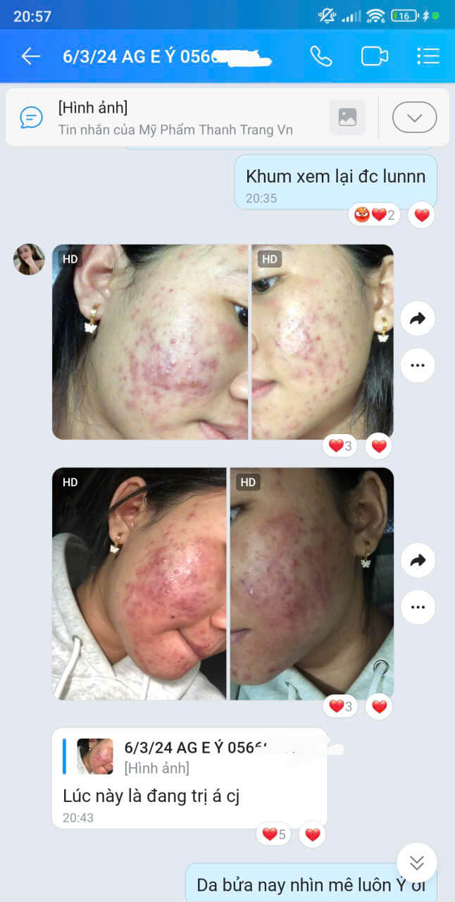 Phản hồi khách hàng xài Linh Chi Vi Mụn Phản hồi khách hàng xài Linh Chi Vi Mụn