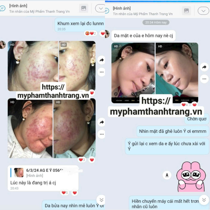 Linh Chi Vi Mụn - Sản phẩm chủ lực trong liệu trình tái tạo da Thanh Trang Khách hàng sử dụng liệu trình tái tạo da Thanh Trang với Linh Chi Vi Mụn để cải thiện tình trạng mụn.