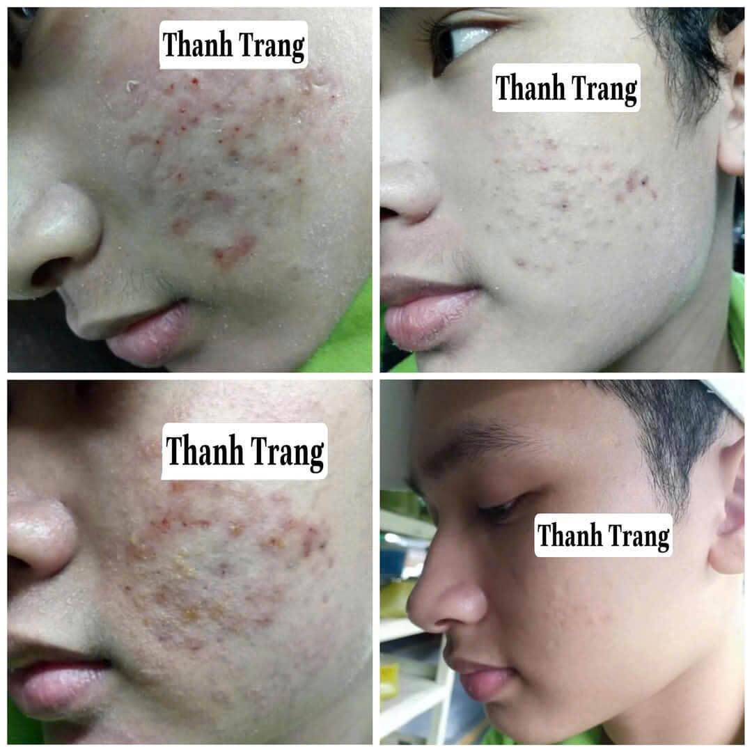 Phản hồi khách hàng xài Linh Chi Vi Mụn Phản hồi khách hàng xài Linh Chi Vi Mụn