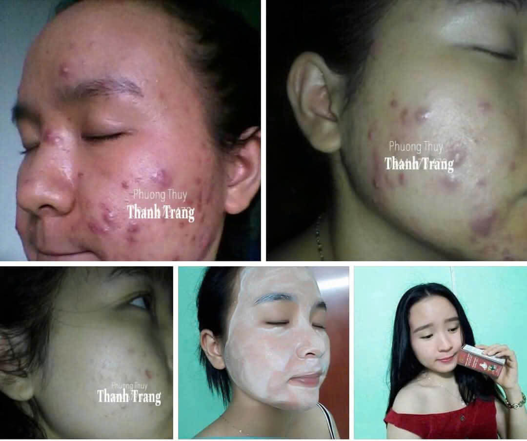 Phản hồi khách hàng xài Linh Chi Vi Mụn Phản hồi khách hàng xài Linh Chi Vi Mụn