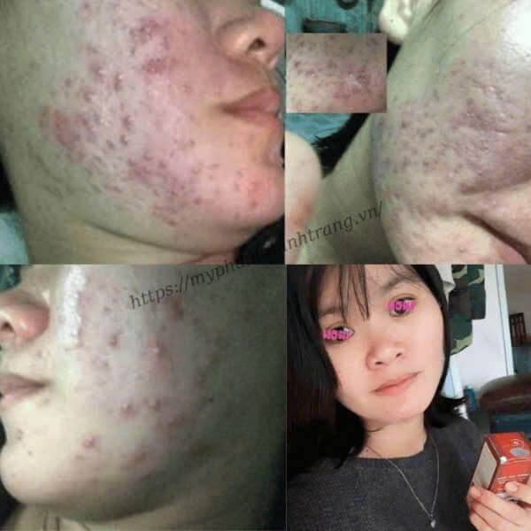 Phản hồi khách hàng xài Linh Chi Vi Mụn Phản hồi khách hàng xài Linh Chi Vi Mụn