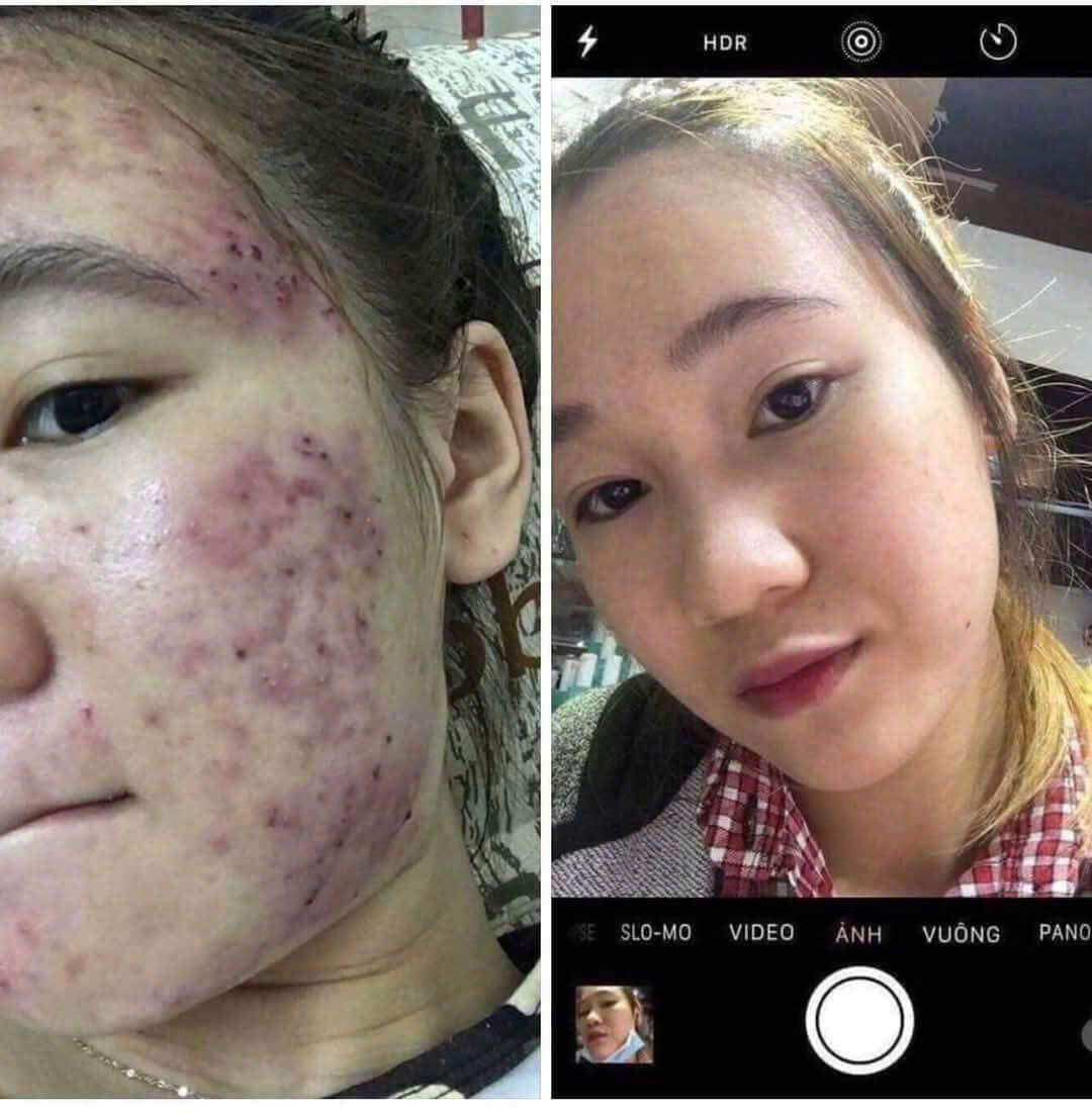 Khách hàng phản hồi xài Linh Chi Vi Mụn kết hợp bột Mask Hoa Hồng Khách hàng phản hồi xài Linh Chi Vi Mụn