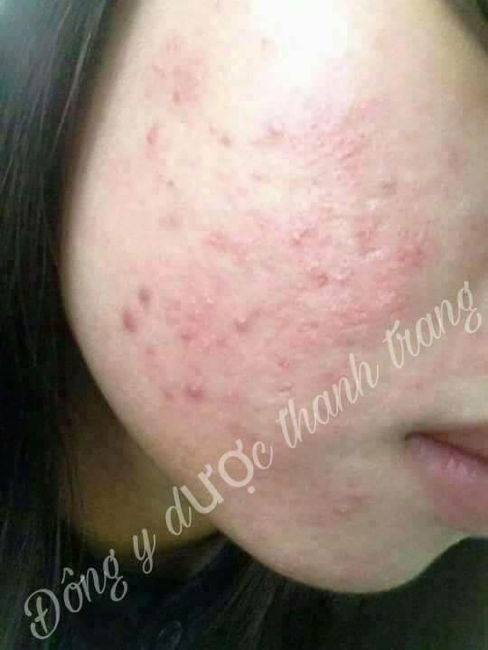 giai đoạn phát triển dung dịch mụn nám Thanh Trang giai đoạn phát triển dung dịch mụn nám Thanh Trang