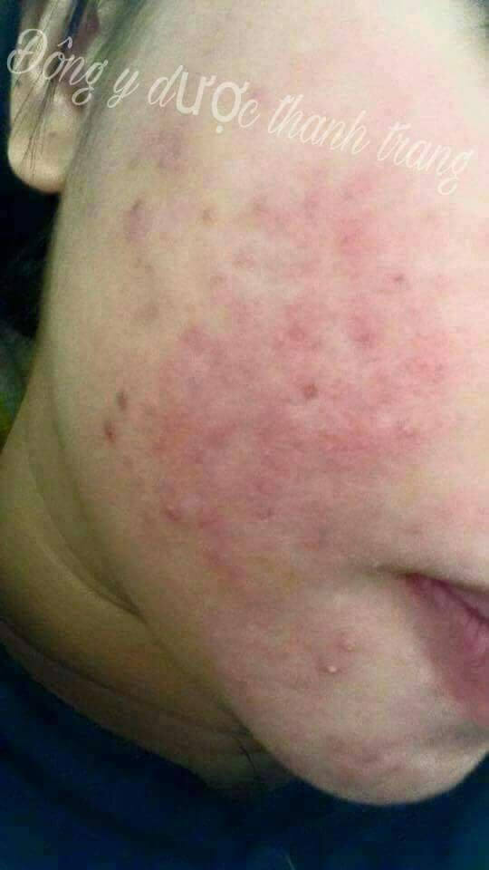 giai đoạn phát triển dung dịch mụn nám Thanh Trang giai đoạn phát triển dung dịch mụn nám Thanh Trang