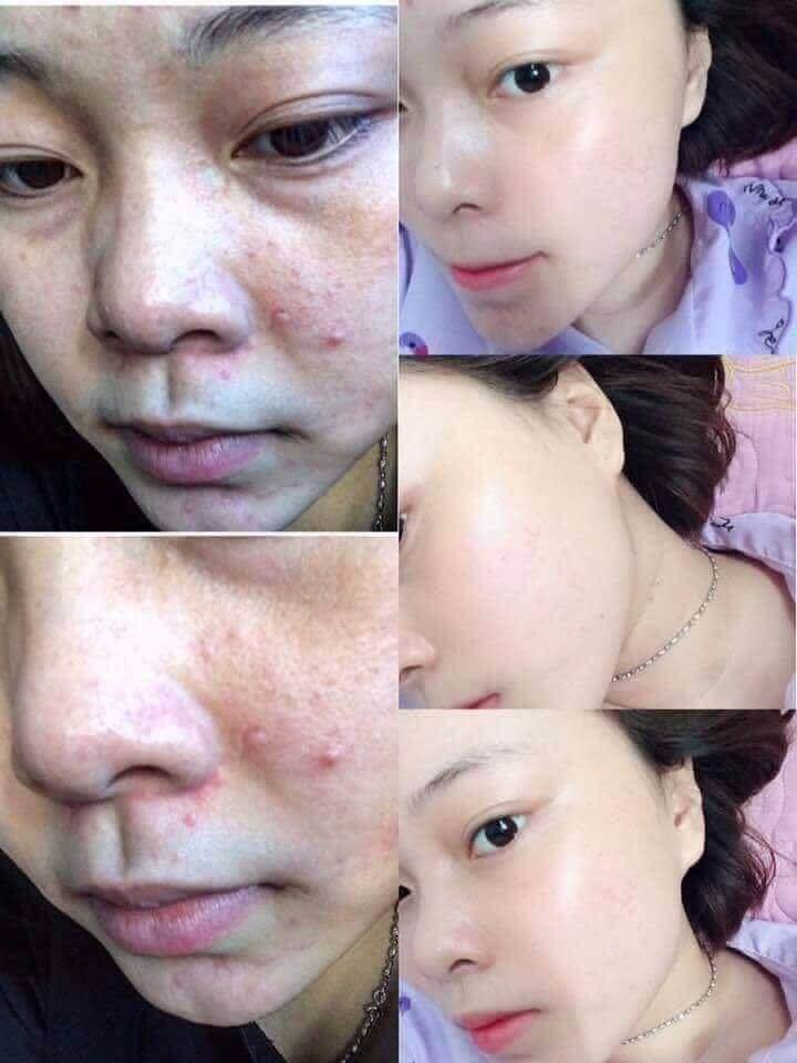 Tái tạo da Thanh Trang: “Thay da đổi thịt” cho làn da yêu hết nấc Tái tạo da Thanh Trang: “Thay da đổi thịt” cho làn da yêu hết nấc