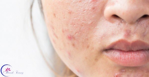 Sai lầm cần tránh khi sử dụng kem trị mụn Thanh Trang Sai lầm cần tránh khi sử dụng kem trị mụn Thanh Trang