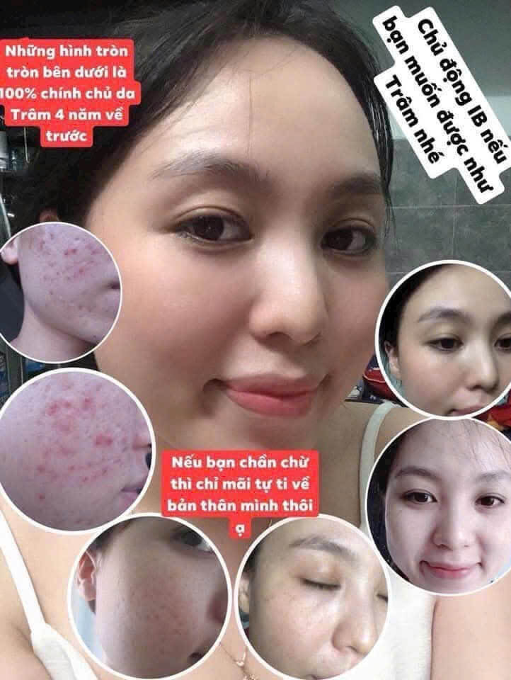 Mụn đỏ giảm rõ, da nhẹ nhàng hơn chỉ sau 1 tháng. Da dịu mát, mụn giảm sưng