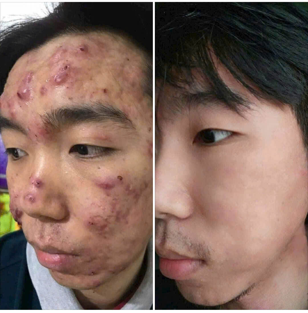 Da dầu sạch mụn viêm, bề mặt mịn hơn sau 2 tháng dùng Linh Chi Vi Mụn Sau 2 tháng sử dụng