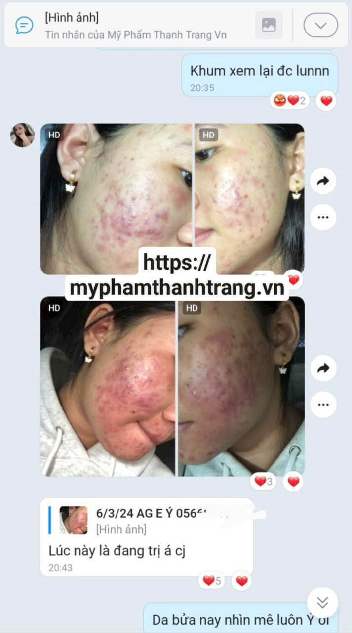 Da dầu đã sạch mụn, lỗ chân lông se khít, bề mặt sáng tự nhiên. Sau 1 tháng sử dụng