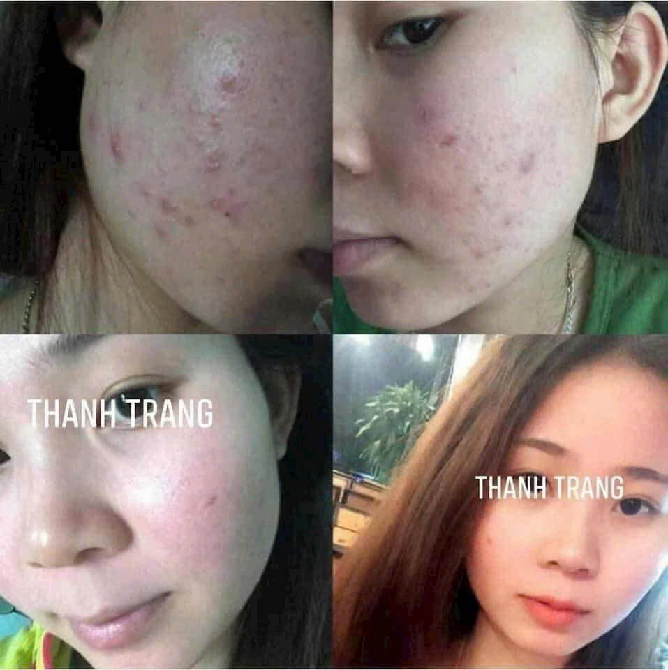Hình ảnh khách hàng sau giai đoạn tái tạo da, tập trung dưỡng ẩm và phục hồi, hạn chế can thiệp mạnh. Duy trì làn da khô khỏe sau tái tạo