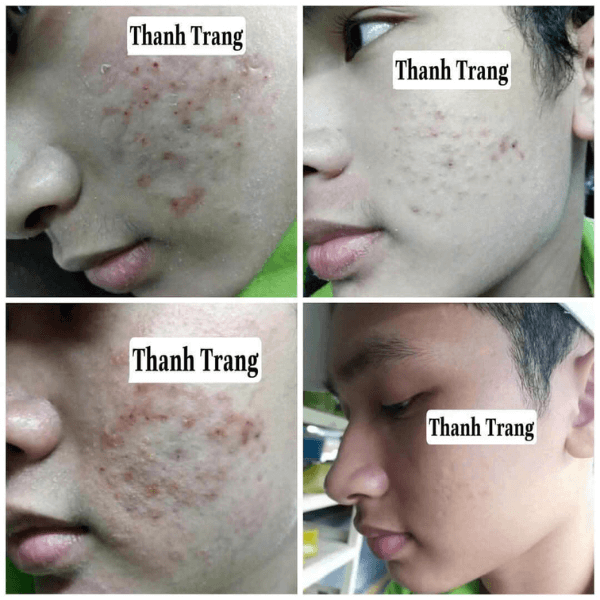 Sau tái tạo, làn da cần thời gian để phục hồi và thích nghi lại với môi trường bên ngoài. Thời gian da ổn định sau tái tạo