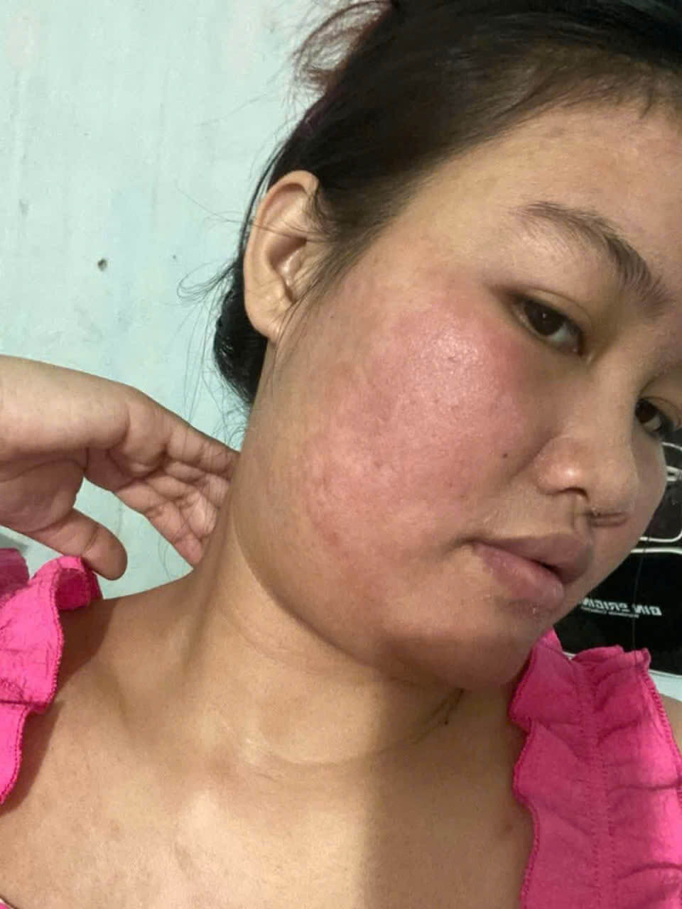 Tái tạo da giai đoạn 1 – đẩy mụn và đào thải độc tố Tái tạo da giai đoạn 1 – đẩy mụn và đào thải độc tố