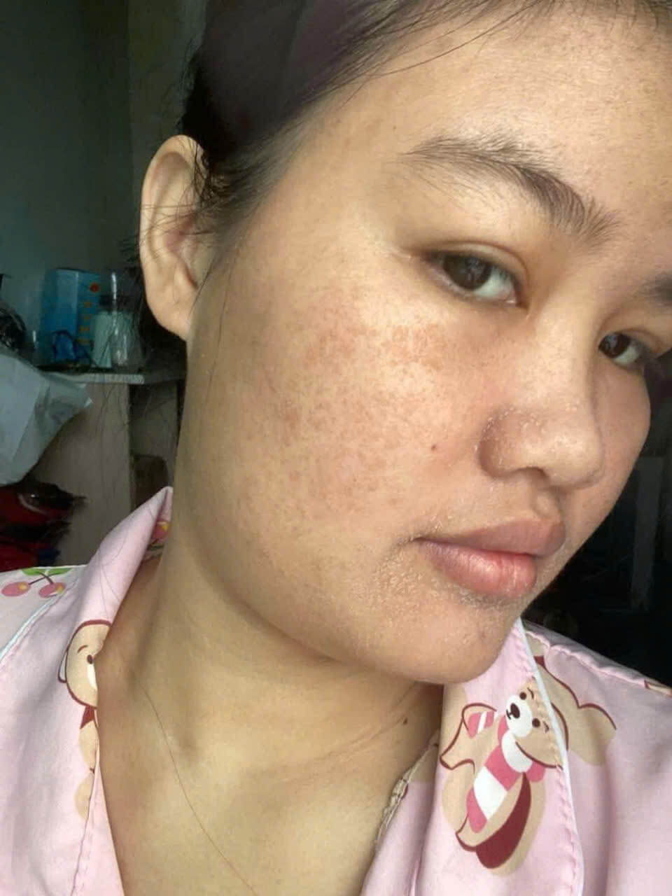 Tái tạo da bao lâu da sẽ đẹp Tái tạo da bao lâu da sẽ đẹp