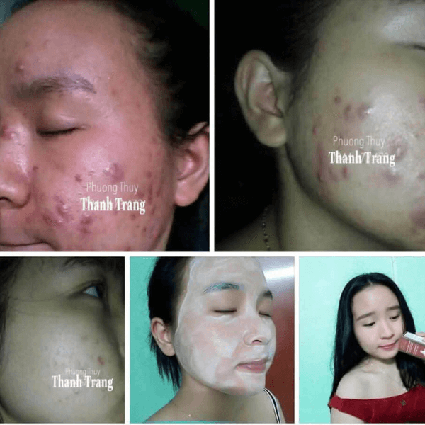 Tình trạng da sau tái tạo theo từng giai đoạn Thời gian da cải thiện sau tái tạo phụ thuộc vào nền da, khoảng cách giữa các lần tái tạo và cách chăm sóc sau đó