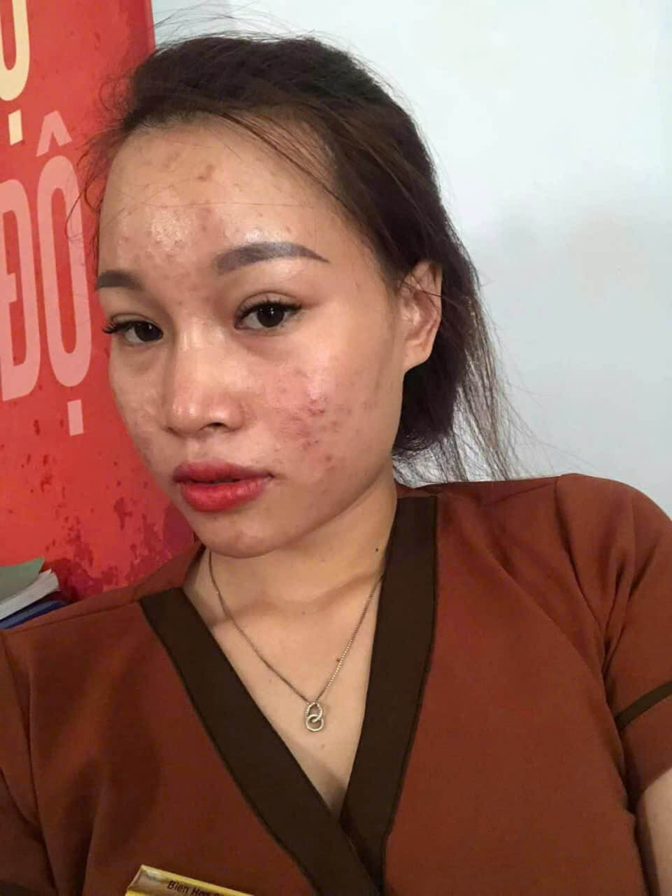 Tái tạo da lần 2 bao lâu thì đẹp? Tái tạo da lần 2 bao lâu thì đẹp?