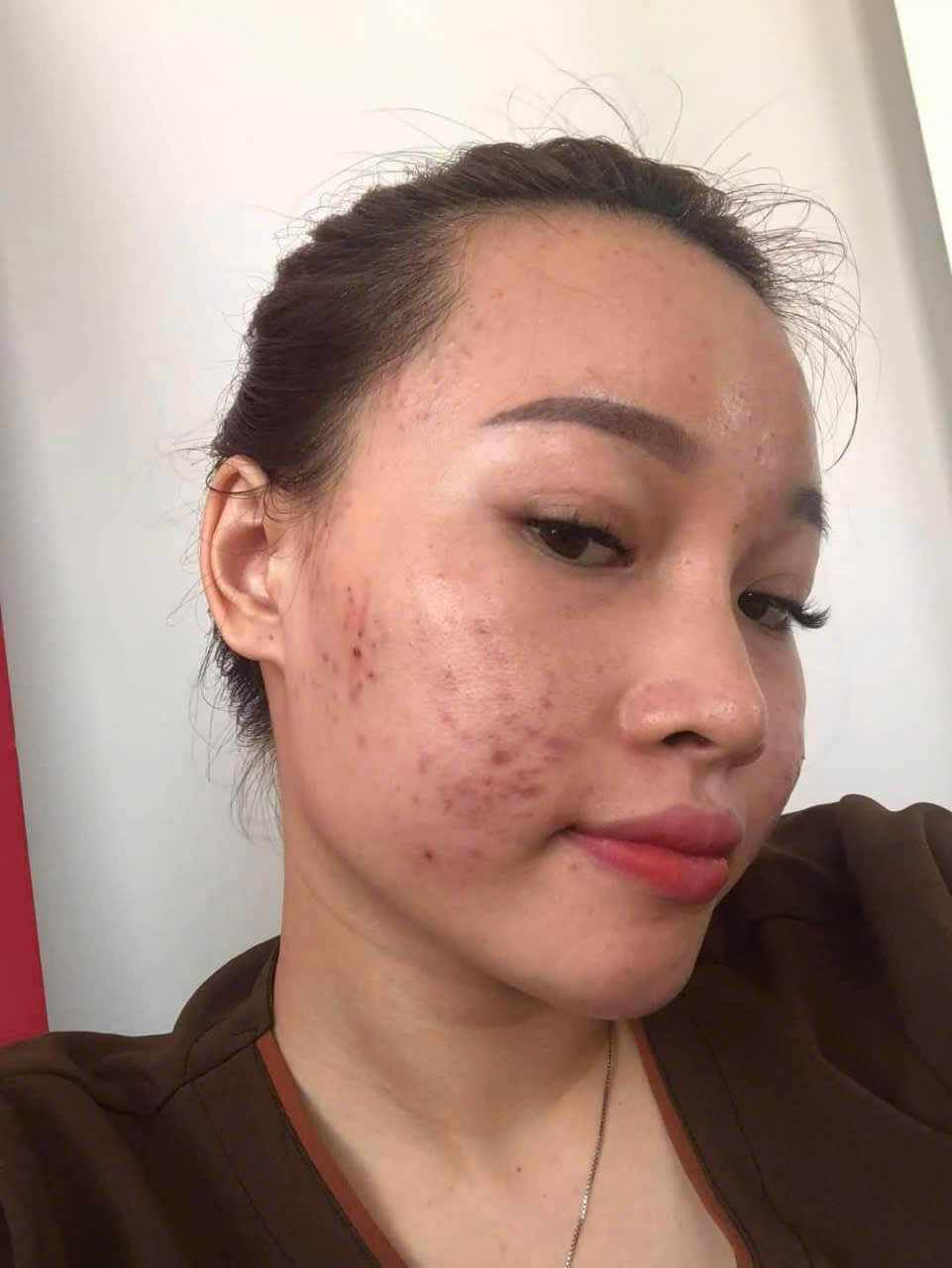 Tái tạo da lần 2 bao lâu thì đẹp? Tái tạo da lần 2 bao lâu thì đẹp?