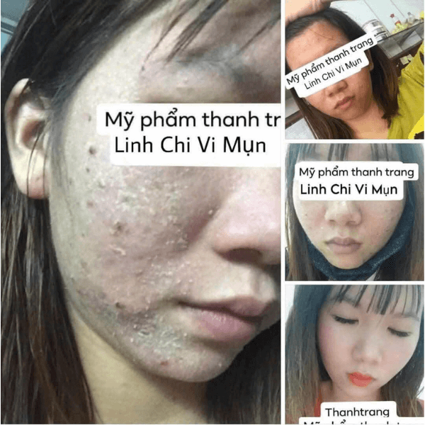 Tái tạo da là quá trình hỗ trợ da tự phục hồi từ bên trong: phục hồi hàng rào bảo vệ da, ổn định chu kỳ tái tạo tế bào, giúp da khỏe lên theo cách tự nhiên. Tái tạo da là gì?