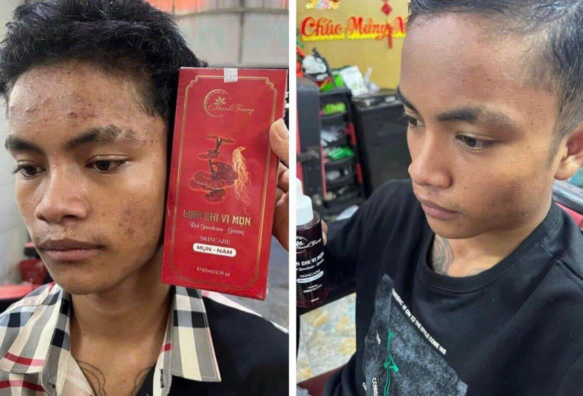 Khách hàng dùng thảo dược linh chi trị mụn Thanh Trang Khách hàng dùng thảo dược linh chi trị mụn Thanh Trang