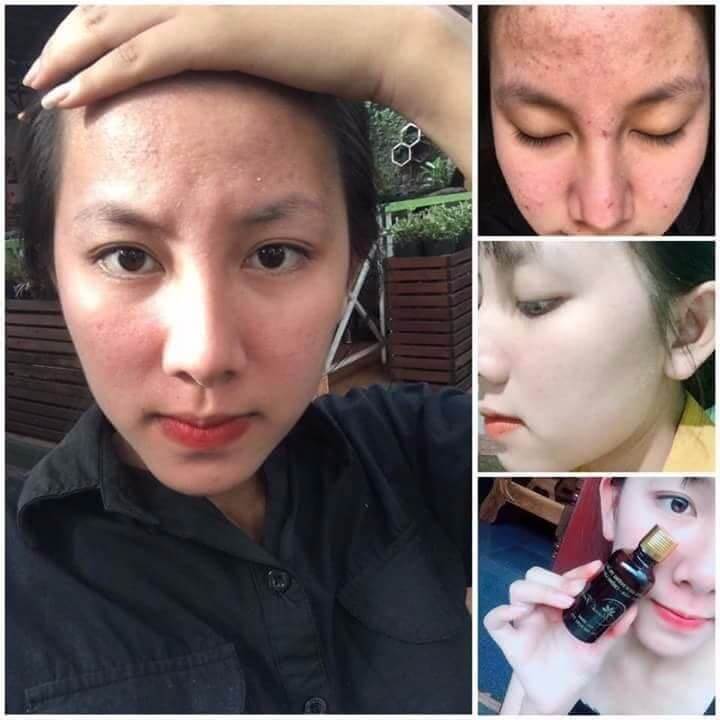 Review đông y Thanh Trang trị mụn và tái tạo da có tốt không? Review đông y Thanh Trang trị mụn và tái tạo da có tốt không?