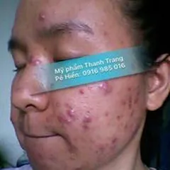 Giai Đoạn Phát Triển Của Dung Dịch Mụn, Nám Thanh Trang (Đông Y Dược Thanh Trang) Như Thế Nào?