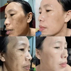 Kem trị nám Melasma mỹ phẩm Thanh Trang – Làm sáng, mờ nám sau peel an toàn