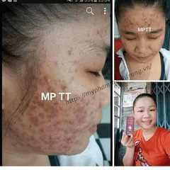 Dung Dịch Mụn Nám Thanh Trang Có Tốt Không?