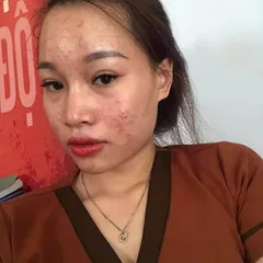 Tái tạo da lần 2 bao lâu thì đẹp?