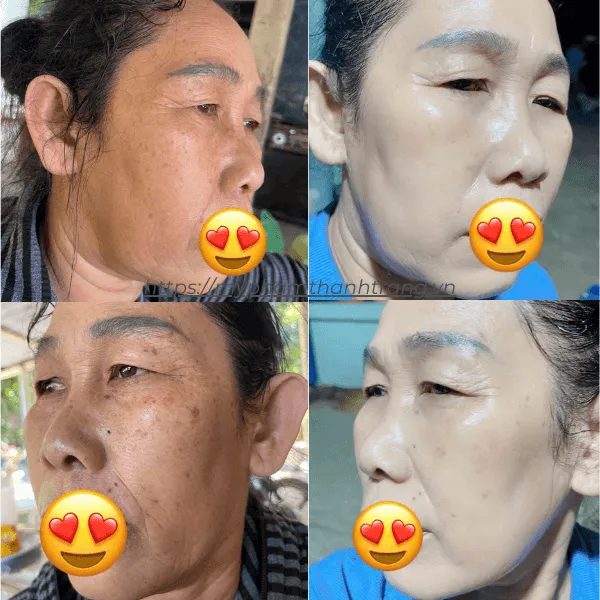 Retinol Peel Da 3 Day Chanbou