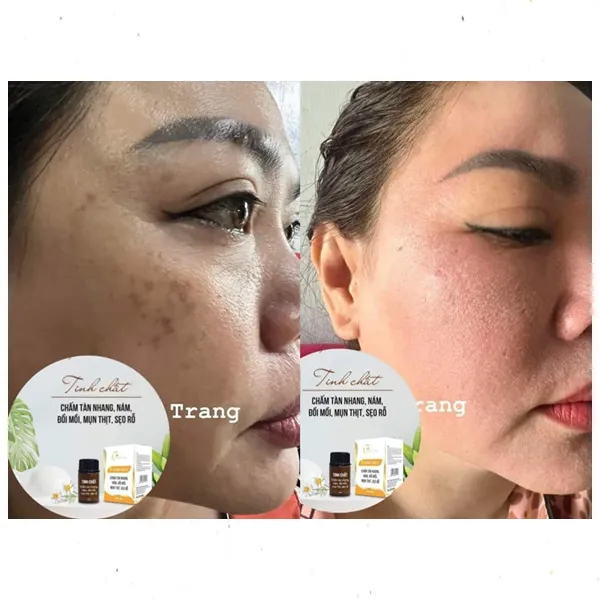Tinh Chất Chấm Tàn Nhang, Nám, Đồi Mồi, Mụn Thịt, Sẹo Rỗ