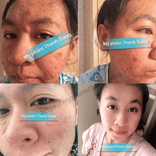 Dung Dịch Mụn - Nám Thanh Trang Cấp Tốc