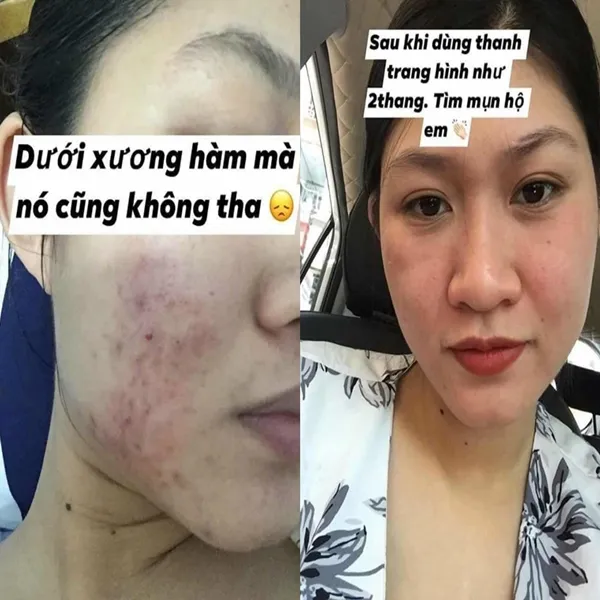 Thảo Dược Tái Tạo Da Linh Chi Vi Mụn