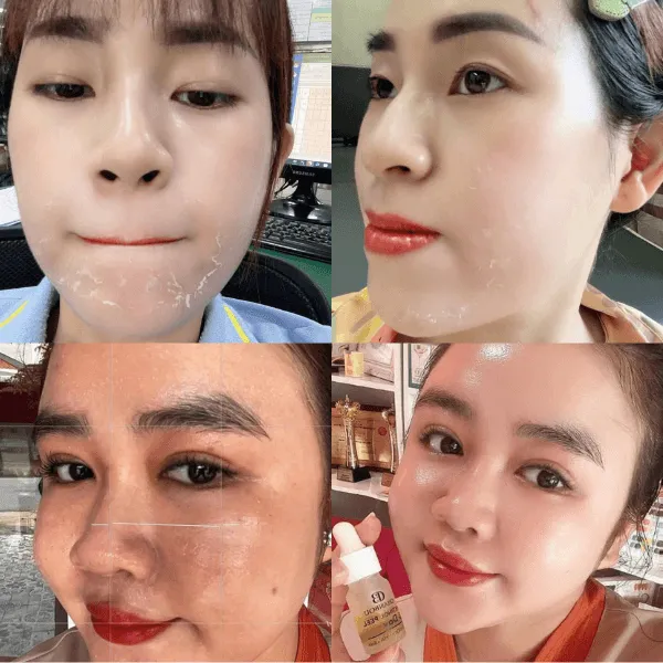 Melasma Cream - Kem Hút Nám Chanbou