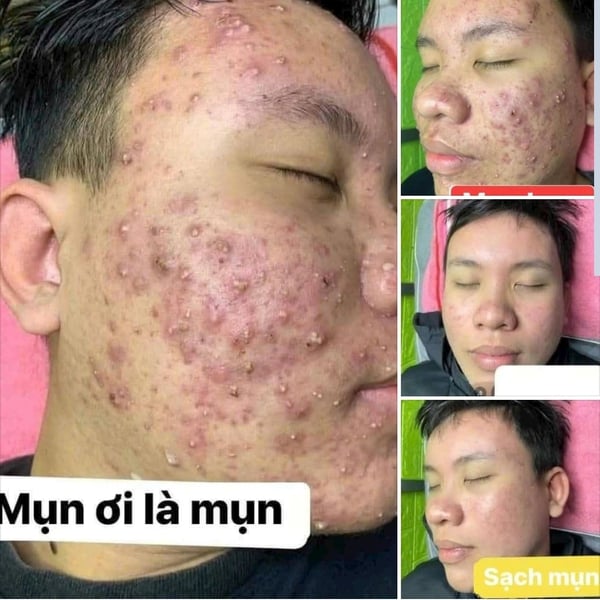 Thảo Dược Tái Tạo Da Linh Chi Vi Mụn