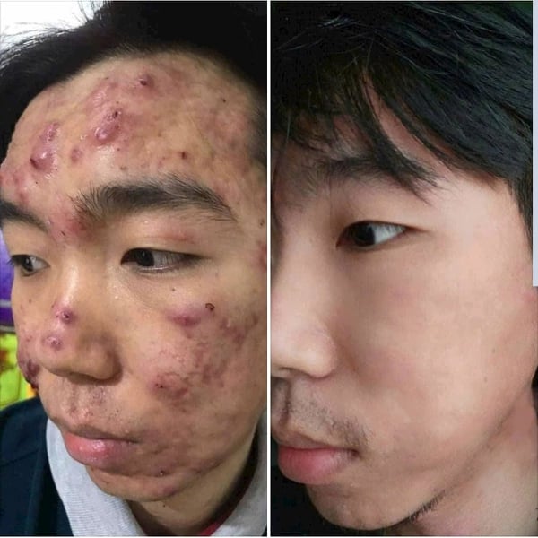 Thảo Dược Tái Tạo Da Linh Chi Vi Mụn