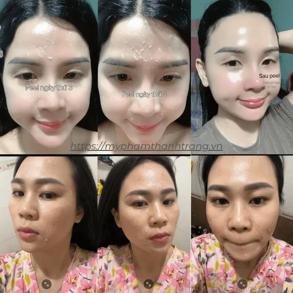 Retinol Peel Da 3 Day Chanbou