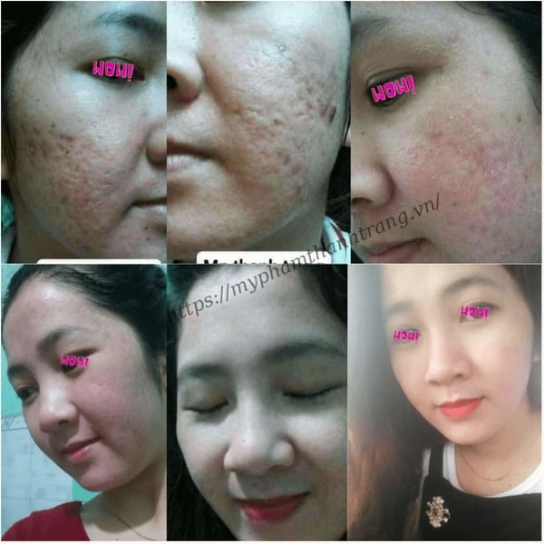 Thảo Dược Tái Tạo Da Linh Chi Vi Mụn