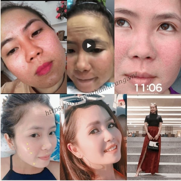 Thảo Dược Tái Tạo Da Linh Chi Vi Mụn