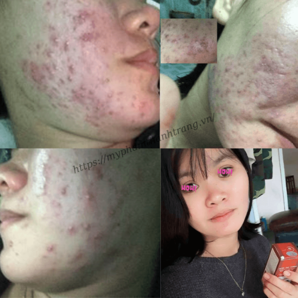 Thảo Dược Tái Tạo Da Linh Chi Vi Mụn