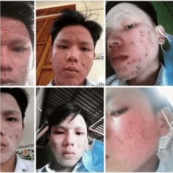 Thảo Dược Tái Tạo Da Linh Chi Vi Mụn