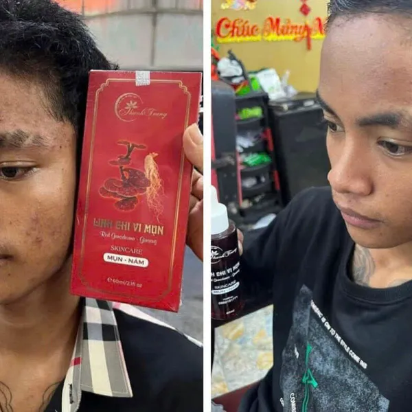 Thảo Dược Tái Tạo Da Linh Chi Vi Mụn