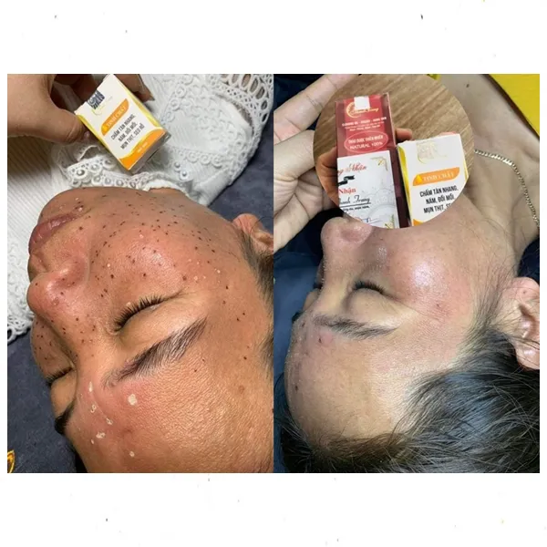 Tinh Chất Chấm Tàn Nhang, Nám, Đồi Mồi, Mụn Thịt, Sẹo Rỗ