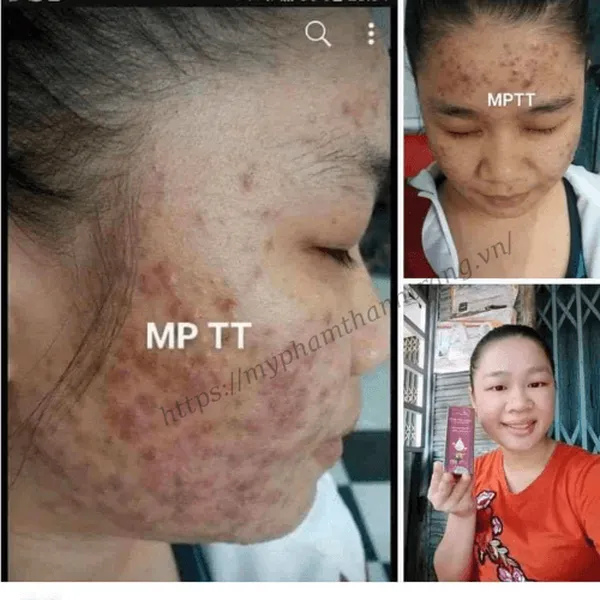 Dung Dịch Mụn - Nám Thanh Trang