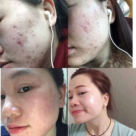 Combo tái tạo da Thanh Trang: “Hồi sinh” làn da từ bên trong Combo tái tạo da Thanh Trang: “Hồi sinh” làn da từ bên trong