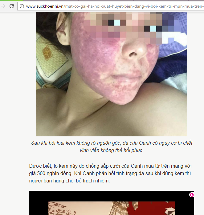 Mỹ Phẩm Thanh Trang - Dung Dịch Mụn Nám Mua Ở Đâu? Mỹ Phẩm Thanh Trang - Dung Dịch Mụn Nám Mua Ở Đâu?