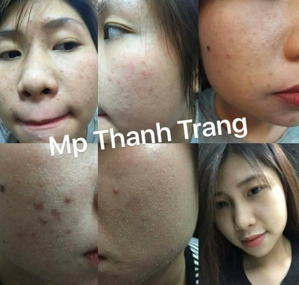 Có nên dùng mỹ phẩm Thanh Trang cho da mỏng yếu và nhạy cảm? Có nên dùng mỹ phẩm Thanh Trang cho da mỏng yếu và nhạy cảm?
