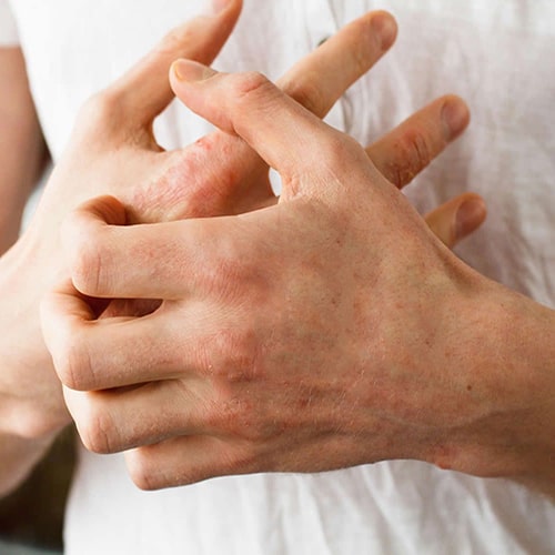 dị ứng da tay dị ứng da tay khi dùng găng tay y tế kém chất lượng