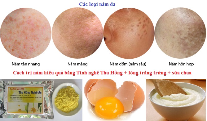 Cách trị nám da bằng tinh bột nghệ Thu Hồng an toàn hiệu quả cao Cách trị nám da bằng tinh bột nghệ Thu Hồng an toàn hiệu quả cao